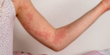 Managing chronic spontaneous urticaria – HealthyWomen
