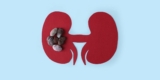 Facts About Kidney Stones – HealthyWomen